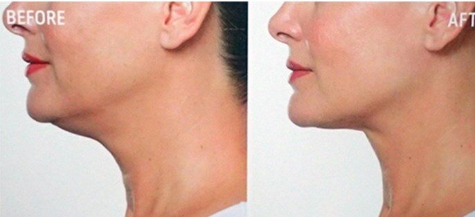 Double Chin Injections